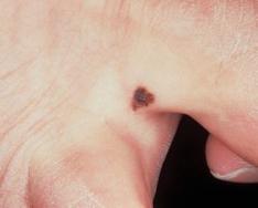 Доброякісні пігментні новоутворення шкіри (родимки) Візуальна відмінність деяких типів невусів